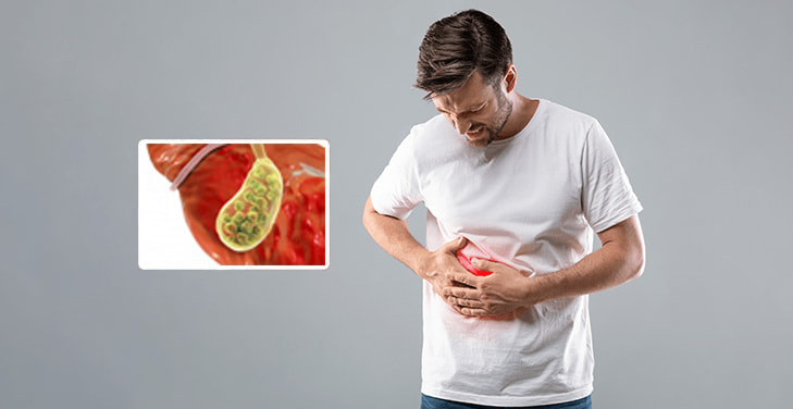 gallstones