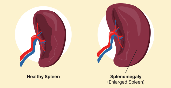 splenomegaly splenomegaly